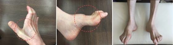 CJ그룹이 공개한 이재현 회장의 샤르코마리투스병 진행 상태 사진. 근육위축으로 손발 모양에 변형이 일어난 모습이다.