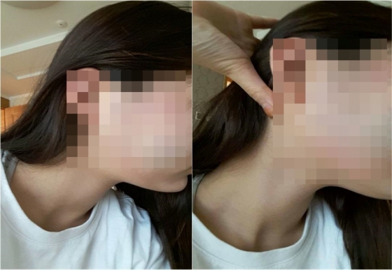 천안 여중생 폭행 피해자라고 주장하는 누리꾼이 공개한 사진. 얼굴에 피멍이 들어 있다./사진=페이스북
