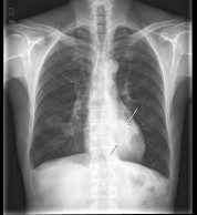 흉부 x-선 촬영 장면. 화살표로 표시된 부분이 암