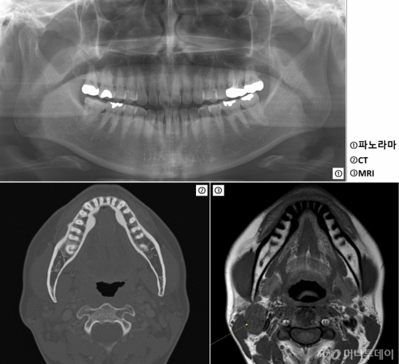 턱관절이 불편해서 온 45세 환자(A씨)의 3가지 영상. 파노라마(위)와 CT(아래 왼쪽)에서는 발견되지 않았던 임파절이 MRI(아래 오른쪽) 영상의 왼쪽(화살표)에 나타났다./사진제공=서울대치과병원