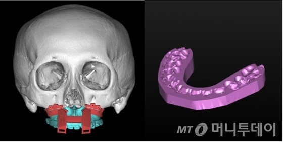 캐드캠(CAD/CAM) 및 3D 프린팅 기술을 이용한 수술 가이드의 제작/사진제공=연세대 치과대학병원