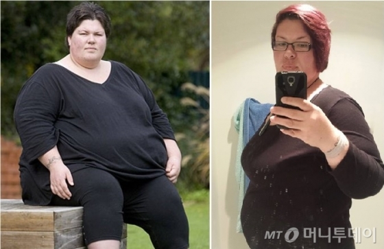 뉴질랜드인 A씨의 2011년 수술 전(왼쪽)과 2015년 임신 성공 후(오른쪽) 사진./사진제공=LHK미래탑의원