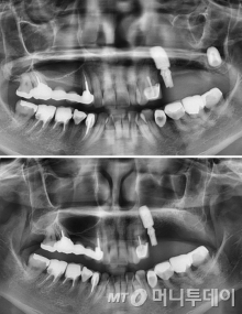 위턱 오른쪽 임플란트 실패 사례(사진 위)와 임플란트 제거후 뼈를 재건한 사례(아래)/사진제공=서울H치과