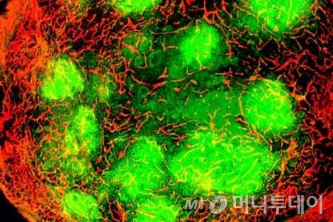 우두 바이러스(펙사벡)에 감염된 종양(푸른 색)이 적혈구들에 둘러싸여 있는 모습./사진제공=신라젠