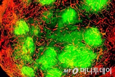 우두 바이러스(펙사벡)에 감염된 종양(푸른 색)이 적혈구들에 둘러싸인 모습
