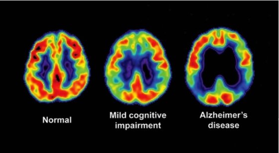 왼쪽부터 정상 뇌, 가벼운 인지능력 저하를 보이는 뇌, 알츠하이머 환자의 뇌. /사진=사이언스소스