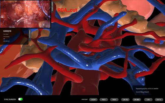 휴톰의 기술력으로 구현한 3D 혈관 
