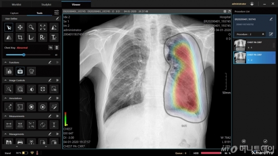 레이언스의 엑스마루 프로가 AI로 검출한 폐렴 관련 소견/사진제공=레이언스