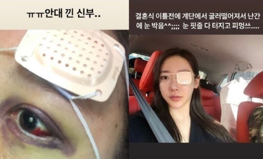 송다예가 2018년 결혼식 이틀 전 공개한 부상 사진/사진=송다예 인스타그램