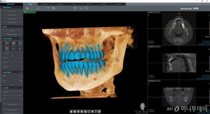 AI기술 특허 및 식약처 허가를 받은 이우소프트의 Quick Tooth Segmentation 영상/사진제공=이우소프트