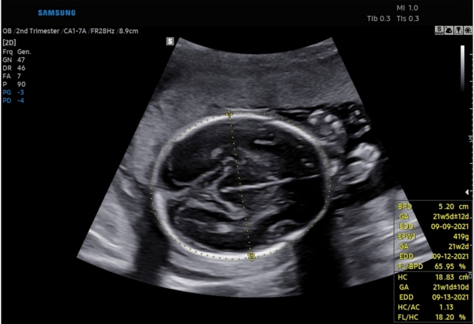 태아 초음파 이미지에서 삼성메디슨의 바이오메트리 솔루션을 활용해 태아의 머리를 자동으로 인지 및 측정해 태아의 성장 정도를 보여주는 화면. /사진제공=삼성메디슨