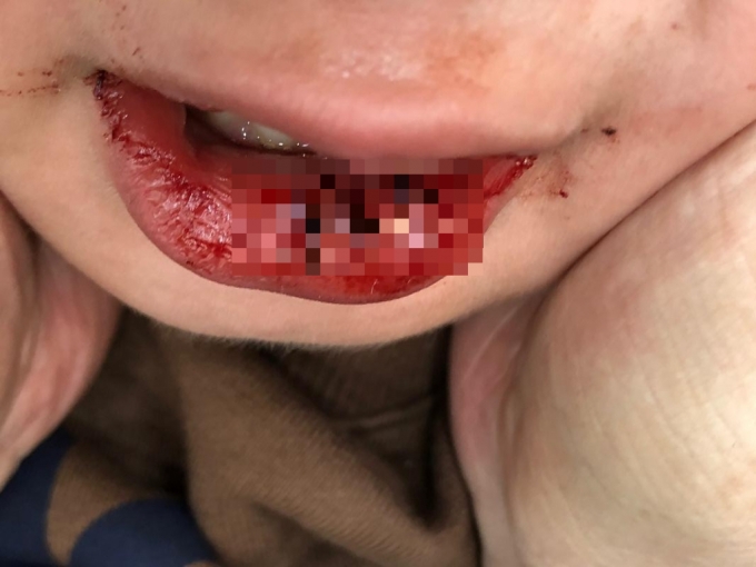 지난달 13일 서울 서대문구 한 어린이집에서 원아(2)가 부딪힘 사고로 이빨이 함몰됐다./사진=보배드림