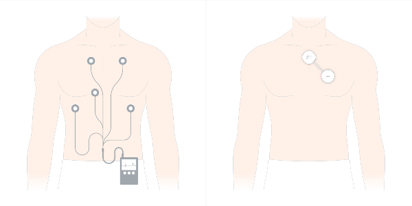 기존 홀터 심전도 검사 방식(왼쪽)과 '메모패치'를 부착한 환자의 비교 이미지. 선을 없애고 크기를 줄여 편의성을 높이면서도 14일간 장기 모니터링이 가능한 것이 차별화 요소다. /자료=휴이노