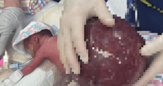 지난 8월9일 호주에서 자기 몸의 2배가 넘는 혹을 꼬리뼈에 달고 태어난 신생아가 장장 6시간의 수술 끝에 기적처럼 살아났다./사진=메이터 성모병원