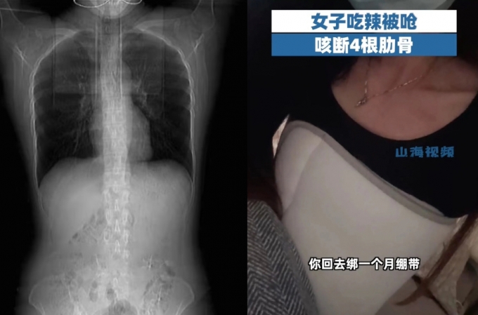중국에서 한 여성이 매운 음식을 먹고 기침하다 갈비뼈가 부러졌다. /사진=SCMP