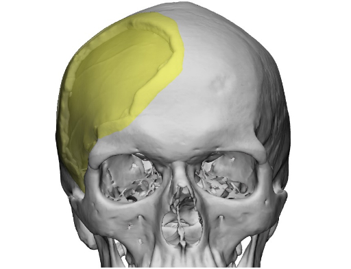  Ƽؾ˹̿ 3D ̿   ΰ ĳ(PSI, Patient Specific Implant)  . /=Ƽؾ˹̿