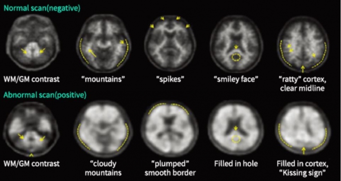 치매 진단 방사성 의약품을 이용해 PET으로 치매 의심 환자의 뇌를 촬영한 모습.  방사성 의약품을 이용하면 뇌 속 아밀로이드베타 축적과 분포 정도를 정확히 알 수 있다./사진제공=듀켐바이오