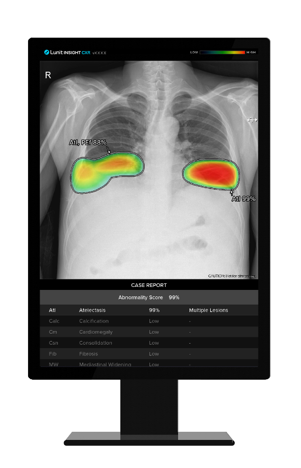 루닛 흉부 엑스레이 AI 영상분석 솔루션 '루닛 인사이트 CXR' /사진=루닛