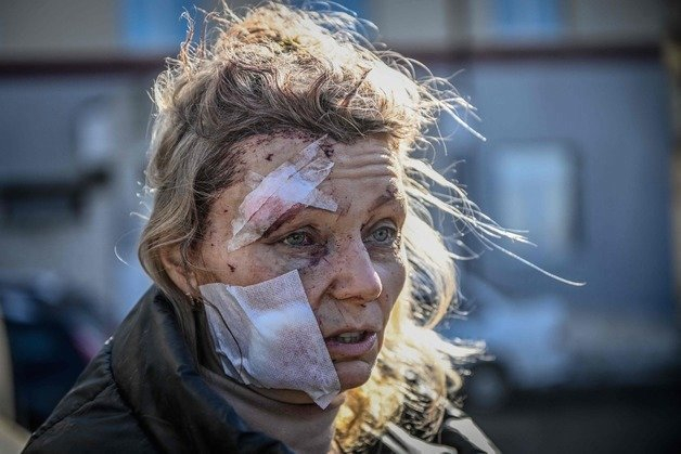 지난해 2월 24일(현지시간) 러시아군의 폭격을 맞은 우크라이나 동부 도시 추위브의 한 아파트 앞에서 얼굴에 상처를 입은 한 여성이 망연자실한 표정을 짓고 있다. (C) AFP=뉴스1