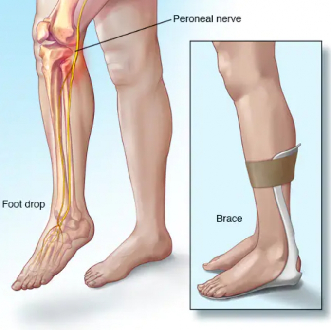뇌졸중 후유증으로 족하수(足下垂, Foot Drop)를 겪는 환자들이 많다. 족하수는 발을 발등 방향으로 젖히지 못하는 질환이다. 발가락이 아래로 처져 걸을 때 발이 땅에 끌리는 상태로, 일반적인 사람보다 발을 더 높이 올려야 걸을 수 있다. 그림으로 볼 때 왼발이 족하수, 오른발이 정상이다. 국내 연구진은 초경량 보행 보조로봇을 개발해 서울대병원 환자 보행을 도왔다. / 사진=미국 메이요 클리닉(Mayo Clinic)