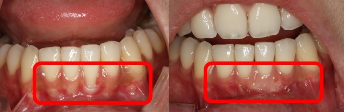 잇몸이 내려앉아 노출된 치아 뿌리 부위(왼쪽)에 잇몸이식술을 실시해 치아 뿌리를 덮은 모습(오른쪽). /사진=관악서울대치과병원