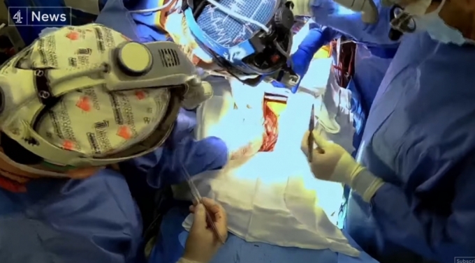 미국 메릴랜드대 연구팀이 2022년 첫 돼지 심장 이식수술을 진행하고 있는 모습. /사진=Channel 4 NEWS 유튜브