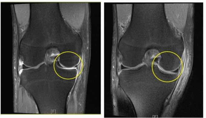 반월상 연골판이 손상당한 환자의 수술 전(왼쪽)과 후 MRI 사진. /사진=서울예스병원