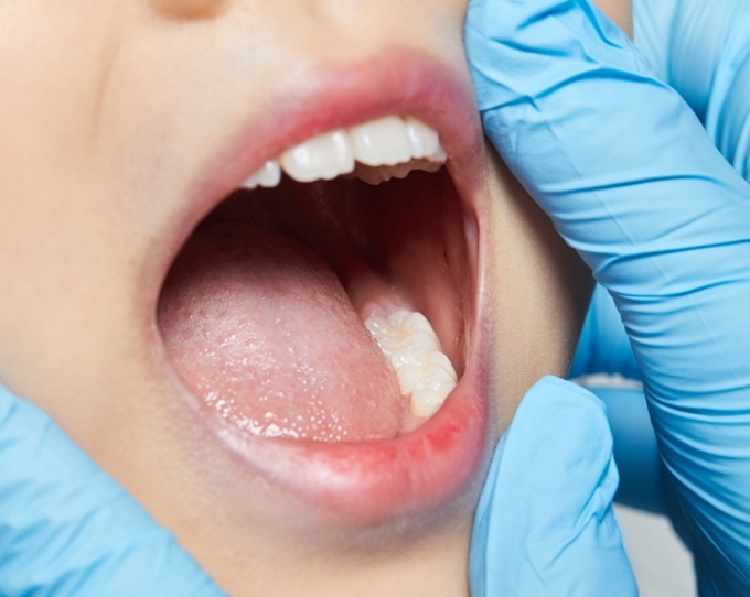 일본 연구진이 세계 최초로 치아를 자라게 하는 약을 개발했다. 올해 말부터 실용화를 위한 임상시험에 돌입한다. /사진=게티이미지뱅크